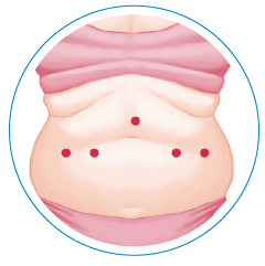 gastric sleeve surgery mexico