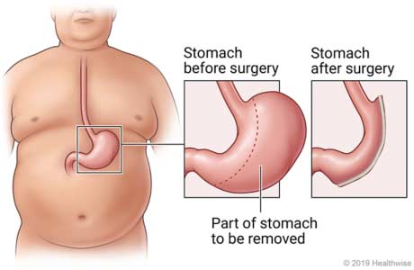 gastric-sleeve-surgery-tijuana