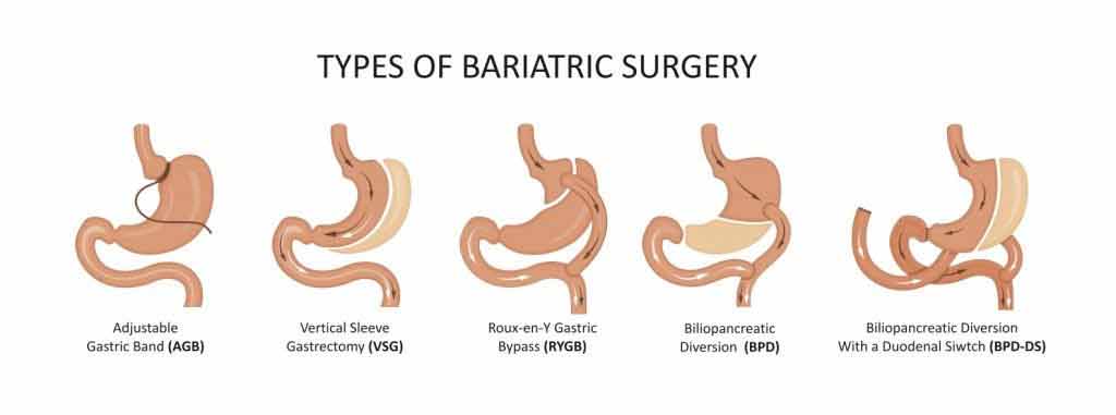 bariatric surgery procedures