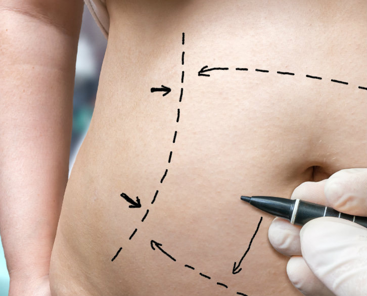 Liposuction and Bariatric Surgery Differences