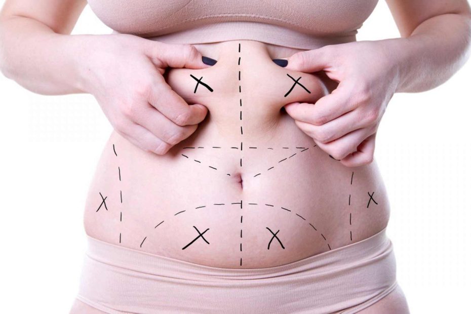 Liposuction or Bariatric Surgery