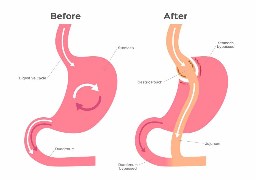 Side effect of gastric bypass