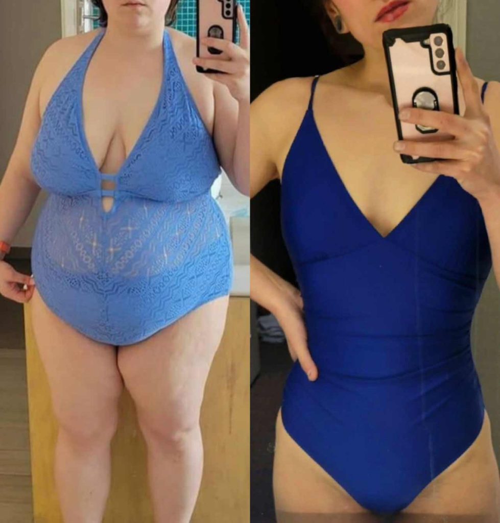 before and after bariatric