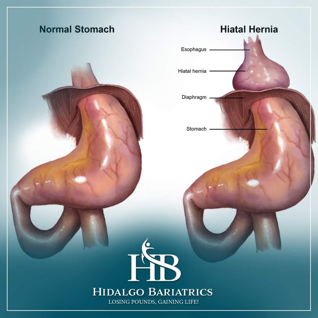 Hiatal Hernia in Bariatric Patients