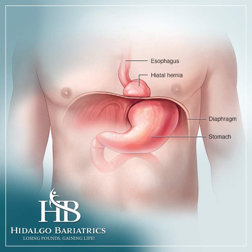 Hiatal Hernia
